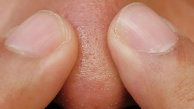 Close up of an adult man's nose which is full of blackheads