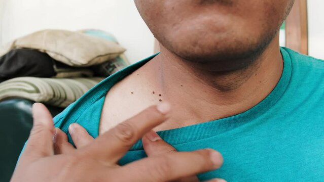 An adult asian man is showing warts growing around his neck