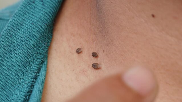 Close up of warts growing around the neck of an adult asian man