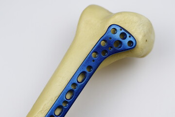 Surgical plates and instruments for osteosynthesis of bone fractures	