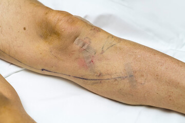 Naklejka premium patient leg after varicose vein surgery