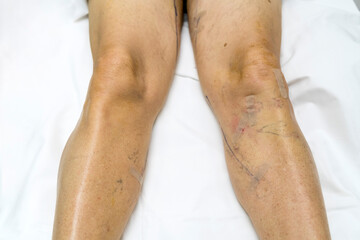patient leg after varicose vein surgery