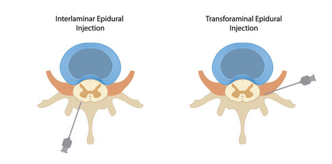 Epidural injection. Illustration of two differents techniques of epidural injection, interlaminar and transforominal - obrazy, fototapety, plakaty