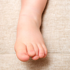 Deformed toes on the foot of the toddler baby, congenital curvature. Kid aged one year and three...