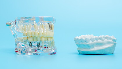 Compare tooth model and tooth model with metal wire dental