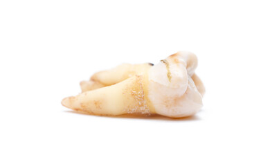 Close-up of a tooth with caries isolated on a white background. Removed wisdom teeth. Sick human teeth.