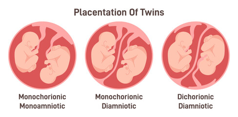 Twin types. Monozygotic or dizygotic placentation of twins, monochorionic