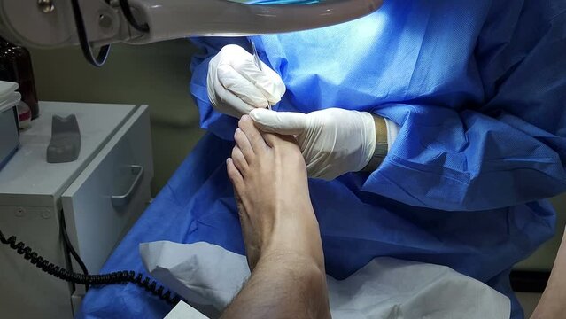 Podiatrist in white gloves clean with cotton a toenail. Concept of podology and chiropody.