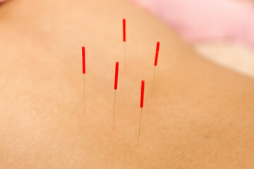 鍼灸・鍼治療