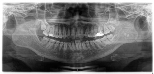Panoramic Dental X-Ray of a Female Patient with Teeth Issues