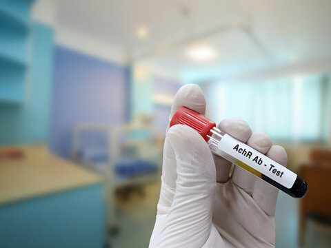 Scientist Holds Blood Sample For AChR Or Acetylcholine Receptor Antibody Test With Patient Bed Background.