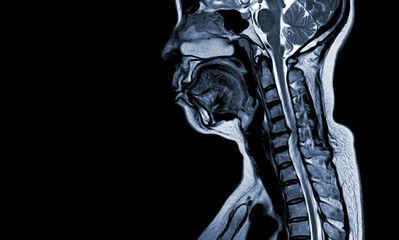 MRI (1.5 tesla) of the cervical spine was performed by sagittal T1W Moderate spinal cord...