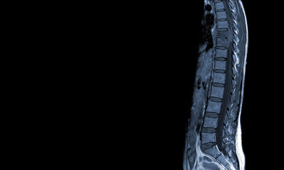 MRI of thoracic spine Moderate pathologic compression fracture of T9 vertebral body with paravertebral abscess at T9-10.