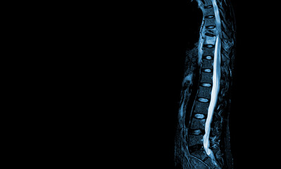 MRI of thoracic spine Moderate pathologic compression fracture of T9 vertebral body with paravertebral abscess at T9-10.