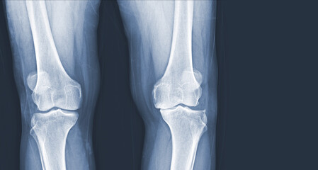 Film x-ray of human knee Osteoarthritis of the Knee normal ligaments Medical image concept.