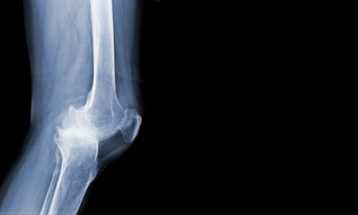 Film x-ray of human knee severe Osteoarthritis of the Knee normal ligaments Medical image concept.