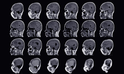 MRI BRAIN Finding of meningioma arising from anterior falx cerebri, extending to bilateral frontal...