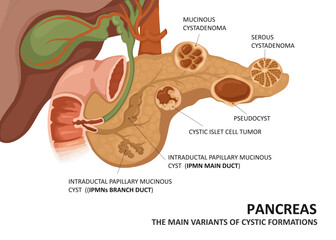 Pancreatic cyst. Main variants of cystic formations (cystadenoma ,pseudocyst etc.) - obrazy, fototapety, plakaty
