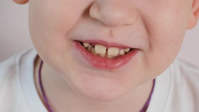 The change of children's milk teeth to molars. The child smiles showing his teeth. A smile with missing teeth. Close-up.