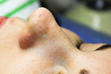 cosmetology. facial skin pollution disappears. clogged sebaceous glands on the face. preparation for cleaning the skin at the beautician. facial pores, facial acne, acne treatment and comedone.