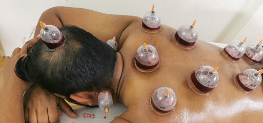 Hijama cupping treatment on men's back