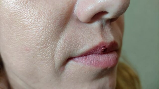 Bloody herpes wound on woman lips