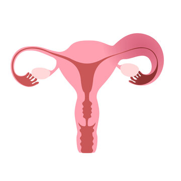 Flat illustration of human uterus demonstrating one healthy and one inflamed fallopian tube.