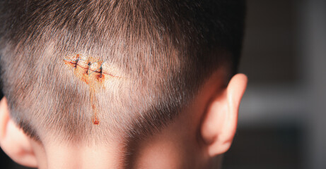 The lacerated sutured wound of kid back head which suture by nylon suture about 3 stitches at the...