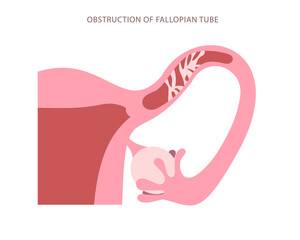 Flat chart of Fallopian tube obstructed. Blockage of womb tube high magnification scheme - obrazy, fototapety, plakaty