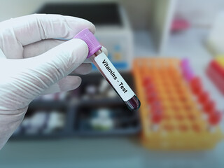Lab Technologist holds blood sample for Vitamins and Minerals test with laboratory background.