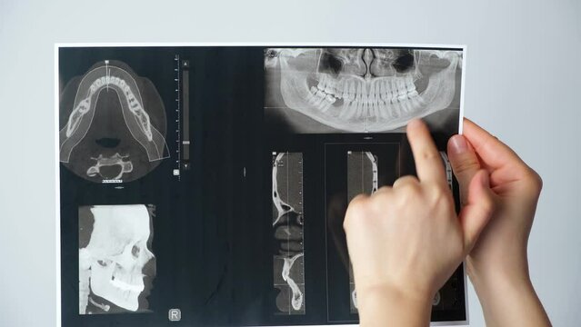 Doctor showing a CT scan of a patient with temporomandibular joint dysfunction and malocclusion.
