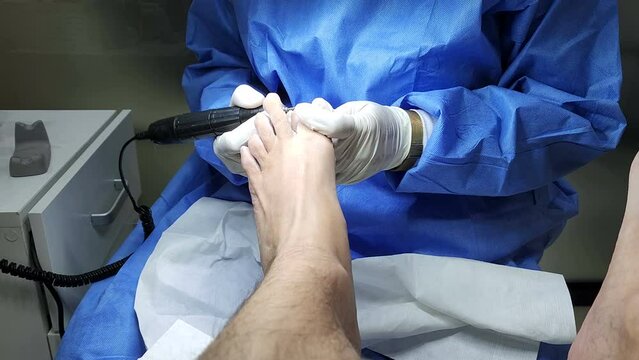 Podiatrist in white gloves clean with cotton a toenail. Concept of podology and chiropody.