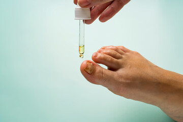 Application of oil from the pipette to a fungus-damaged nail strengthened with titanium thread