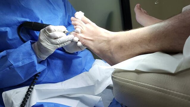 Podiatrist in white gloves clean with cotton a toenail. Concept of podology and chiropody.