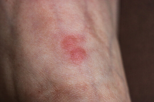 Red inflammation from damage to human skin after an insect bite. An ant bite to the skin of the foot.