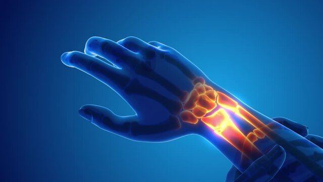 Broken Wrist bone pain medical concept