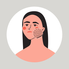 Young woman with dry facial skin. Zoom circle showing problem with skin. Skin care and rejuvenation concept. Flat vector illustration