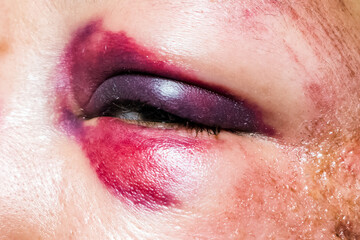 Woman with colorful Black Eye. Shiner.