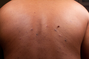 Fototapeta na wymiar human skin texture. wart and pimples on skin micro photo. close up photo.