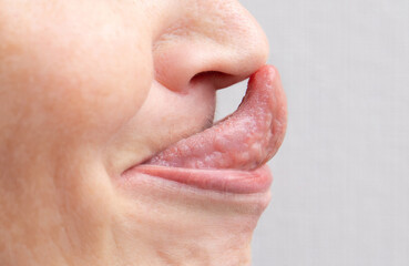 The Gorlin sign is a medical term that indicates the ability to touch the tip of the nose with the...