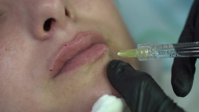 Woman undergoes lip plumping procedure. Master of cosmetic services makes injection from transparent syringe into lady upper lip extreme closeup