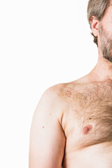 Naklejka premium shoulder arthroscopic surgery operation. metal staple suture traumatologist treatment. man