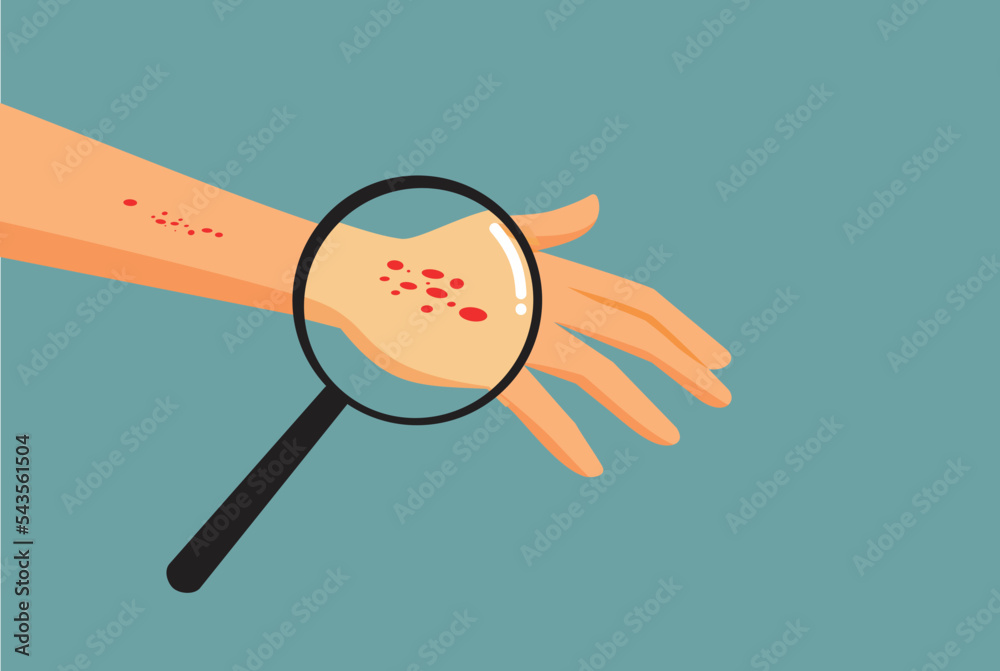 Wall mural Person Suffering a Rash on His Hand Vector Medical Concept Illustration. Hand with red dots symptom of skin condition 
