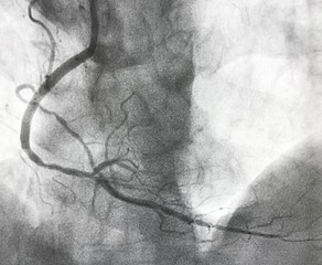 Coronary angiogram (CAG) shown right coronary artery.