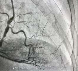 Coronary angiogram (CAG) shown right coronary artery stenosis and given collateral arteries to...