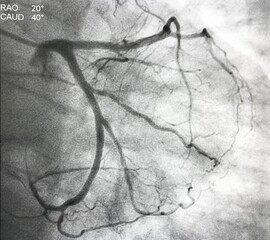 Coronary angiogram (CAG) of left coronary artery (LCA).