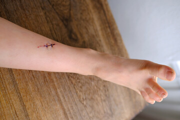 fresh wound on child's leg, non-absorbable sutures, wound care after skin procedure with sutures,...