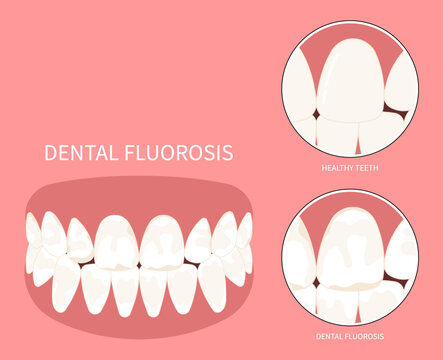 Teeth discolored in Dental with Fluorosis pitted of grooved Turner's hypoplasia