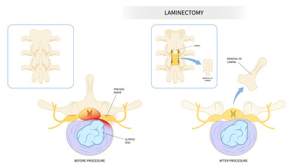 compressed back nerve lumbar of annular tear laminectomy spine cord surgery root muscle pain disc tumor cancer cyst bone spurs vertebrae weakness diskectomy anterior fusion transforaminal replacement