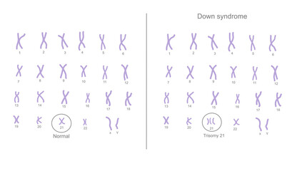 The chromosome 21 are changed the copy number from normal (2 copies) to abnormal (extra) chromosome (3 copies) that call Trisomy 21: Down syndrome